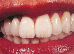 Teeth after cosmetic crown restoration — natural and bright