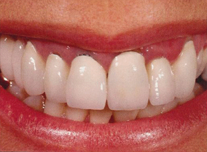 Teeth before cosmetic crown work — discoloured and uneven