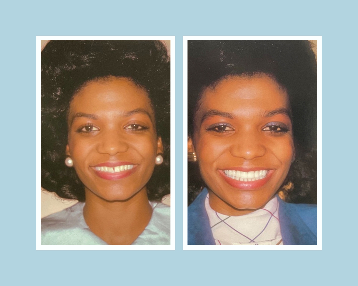 Smile makeover before and after — complete veneer transformation showing dramatically improved smile