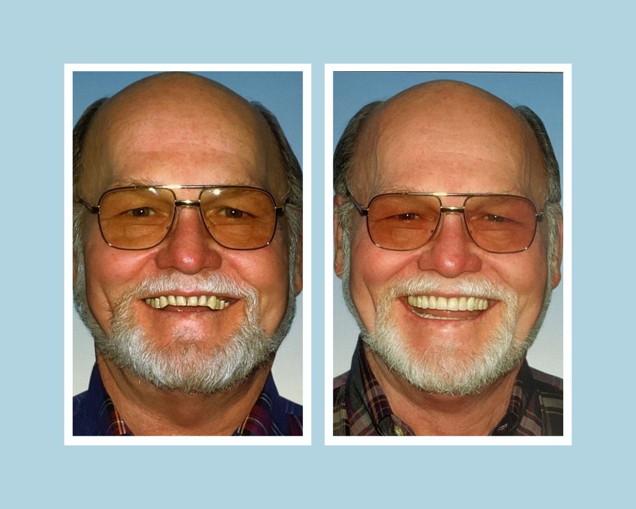 Crown and bridge work before and after — worn teeth restored to full, bright smile
