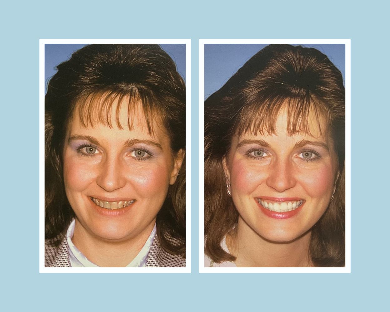 Before and after veneers and crowns — stained teeth restored to bright, even smile