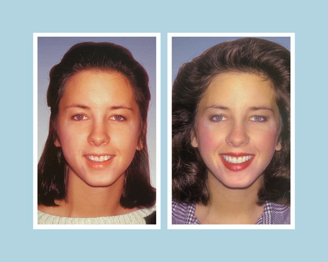 Cosmetic veneer transformation — crooked teeth corrected to straight, beautiful smile