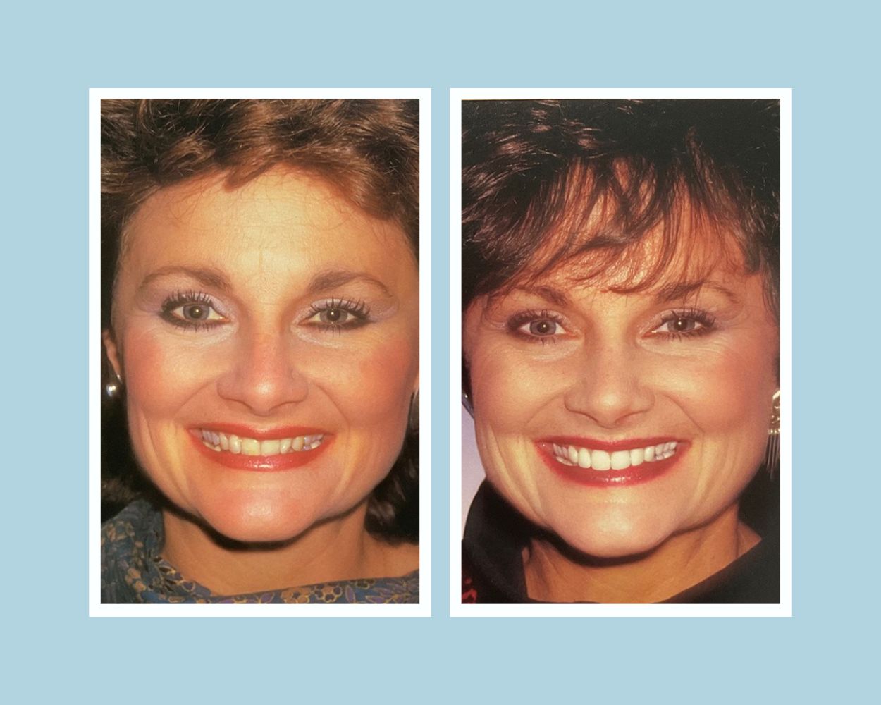 Full smile makeover before and after — complete transformation with veneers and crowns