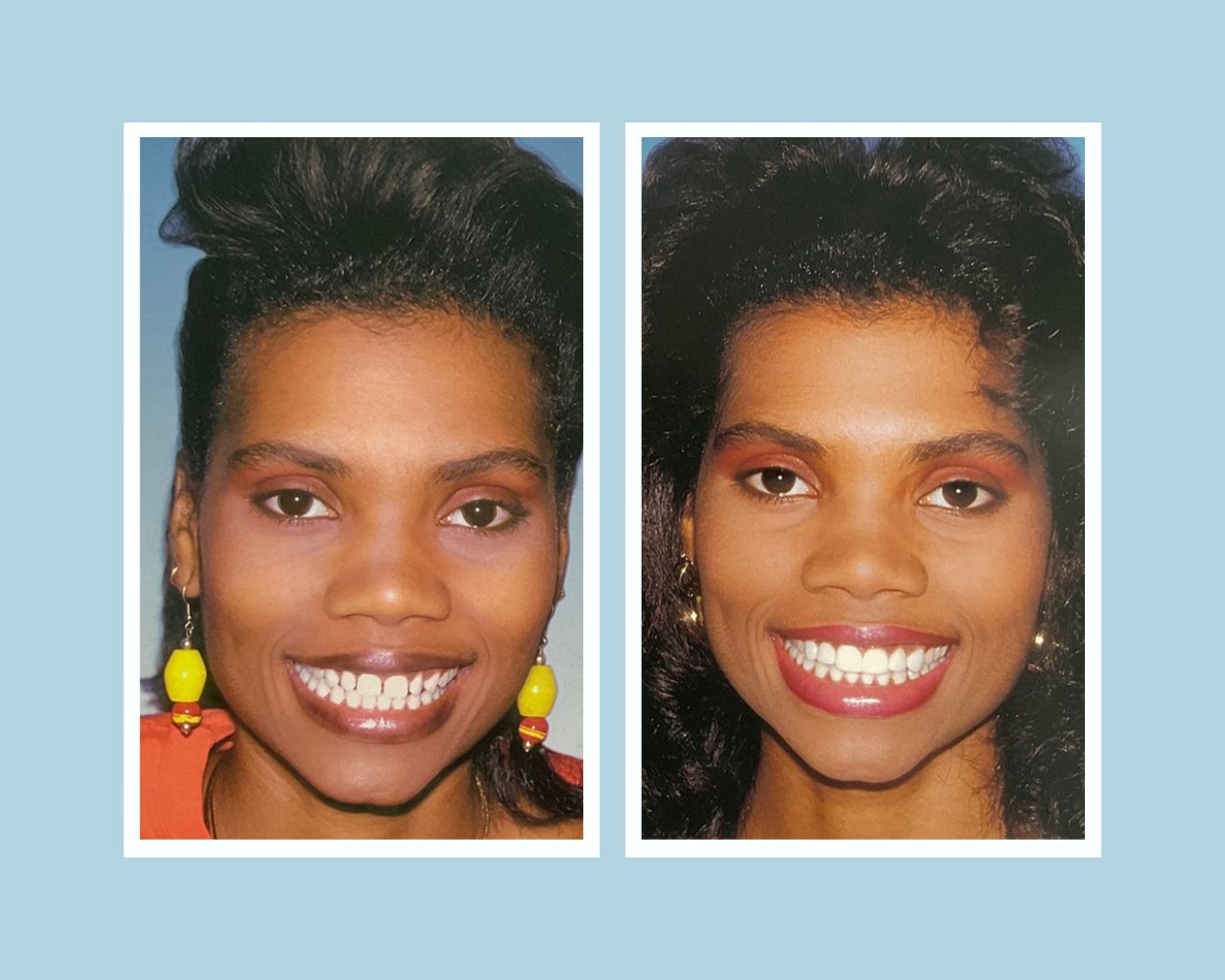 Complete cosmetic dentistry transformation — gum contouring with veneers