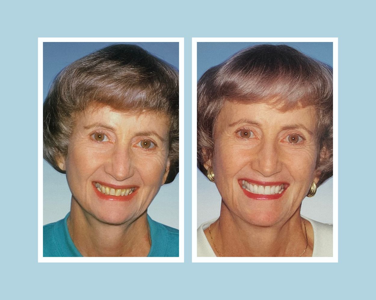 Cosmetic crown restoration before and after — yellowed teeth restored to white, uniform smile