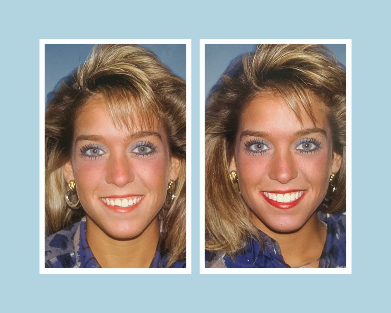 Porcelain veneer makeover — chipped teeth restored to uniform, natural smile