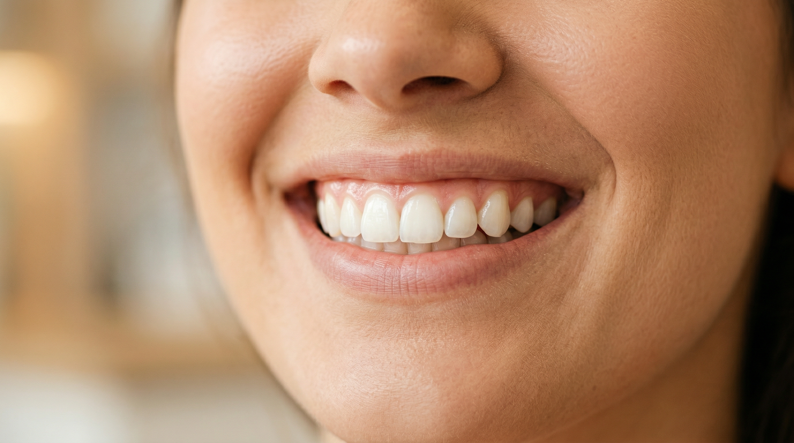 Beautiful smile transformation - before and after veneers